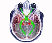 Optic chiasma, DTI MRI scan