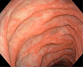 Erythematous duodenitis, endoscope view