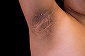 Acanthosis nigricans