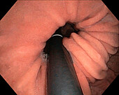 Cardia of the stomach, endoscope view