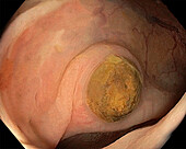 Stercolith in colon with diverticulosis, endoscope view