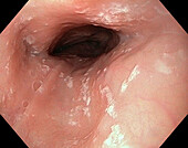Candidiasis of the oesophagus, endoscope view