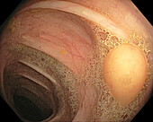 Lipoma in the colon, endoscope view