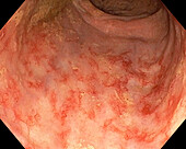 Rectitis by irradiation, endoscope view