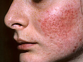 Acne vulgaris