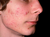 Acne vulgaris