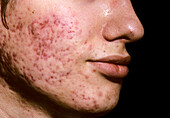 Acne vulgaris