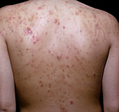 Acne vulgaris
