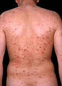 Acne vulgaris