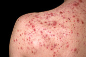 Acne conglobata