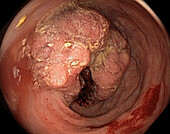 Colon cancer, adenocarcinoma, endoscope view
