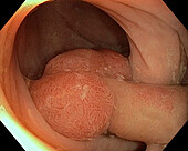 Colon polyp, endoscope view