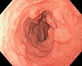 Inflammatory bulbitis, endoscope view