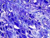 Thyroid gland vesicular adenoma, light micrograph