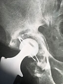 Damaged hip replacement, X-ray
