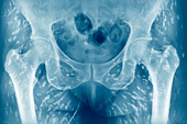 Cysticercosis, X-ray