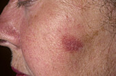 Lever's facial granuloma