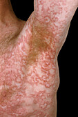 Pellagroid erythema rash