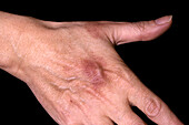 Lesion on hand in fixed drug eruption