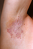 Hailey-Hailey disease lesion