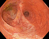 Ileocolic anastomosis, endoscope view