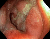 Diverticular sigmoiditis, endoscope view
