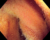 Surface of the ileum, endoscope view