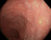 Atrophic gastritis with metaplasia, endoscope view