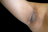 Acanthosis nigricans
