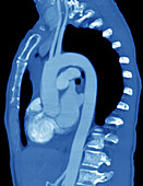 Heart and aorta, CT scan