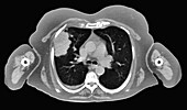 Primary adenocarcinoma lung cancer, CT scan
