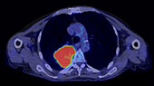 Primary adenocarcinoma lung cancer, PET scan