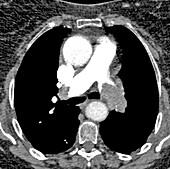 Pulmonary embolism, axial CT scan