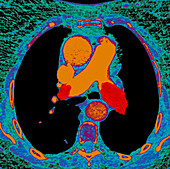 Pulmonary embolism, axial CT scan