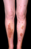 Diabetic skin lesions