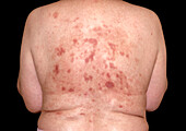 Seborrhoeic pemphigus lesions