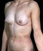 Recklinghausen's disease