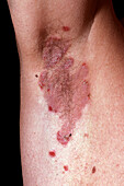 Seborrhoeic pemphigus lesions