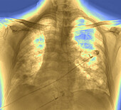 Lungs affected by Covid-19 pneumonia, X-ray