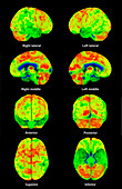 Alzheimer's disease, 3D PET scans