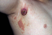 Langerhans cell histiocytosis