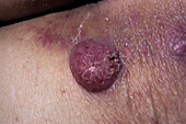 Cutaneous lymphoma
