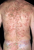 Seborrhoeic pemphigus lesions