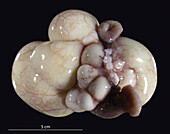 Malformed lymph vessels