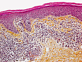 Sezary syndrome, light micrograph