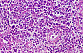 Sezary syndrome, light micrograph