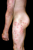 Pediculosis