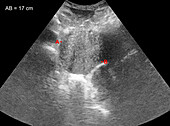 Pancreatic cancer, ultrasound scan