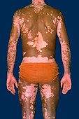 Vitiligo