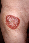 Skin in mycosis fungoides cancer